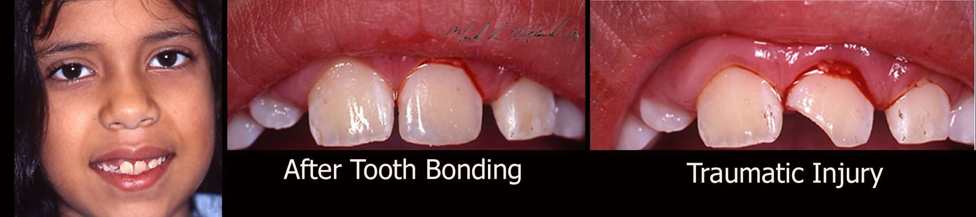 tooth broken bonding