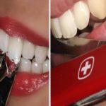 dental injury tooth trauma