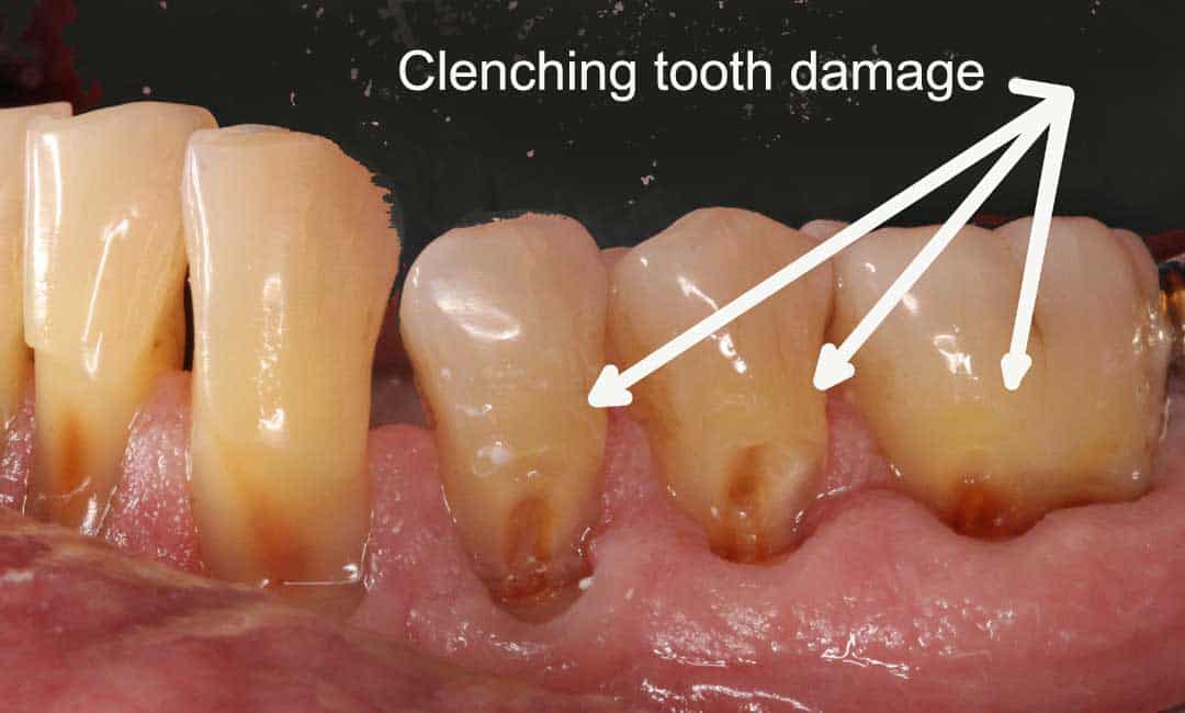 severe tooth damage from grinding