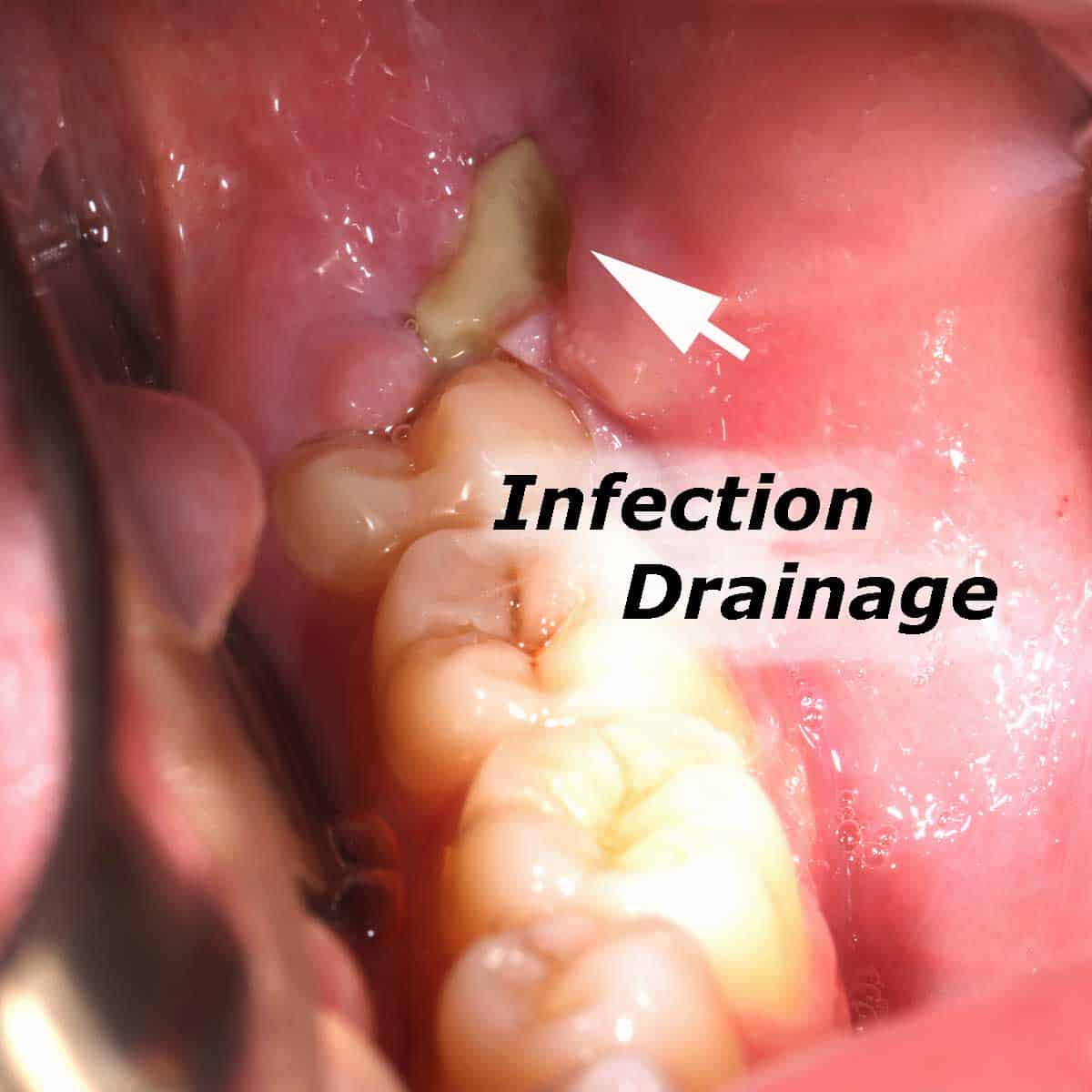 Impacted and infected wisdom tooth