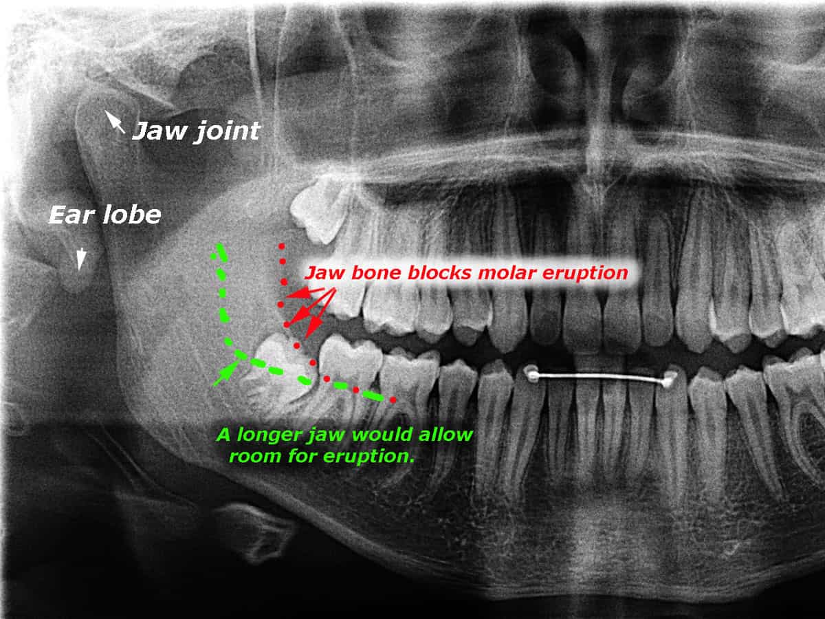 dental x-ray why impaction occurs