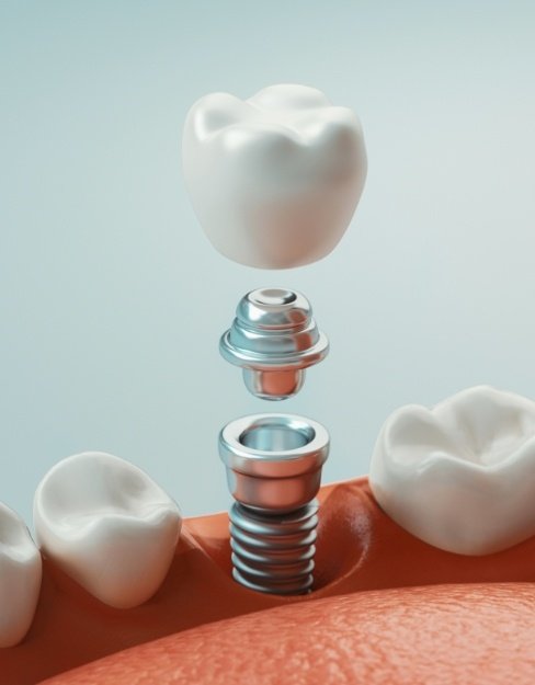 Animated smile showing parts of a dental implant supported replacement tooth