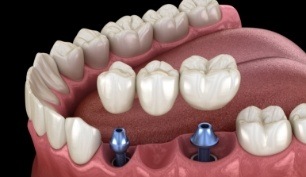 Animated smile during dental implant supported bridge placement