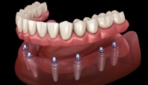 Animated smile during dental implant supported denture