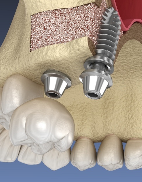 Animated smile with dental implants placed after bone grafting