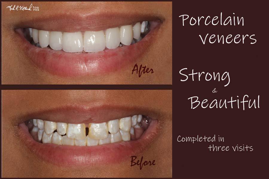 Smile before and after porcelain veneer treatment