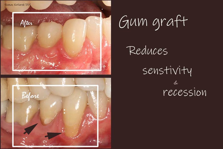 Smile before anda fter gum graft procedure