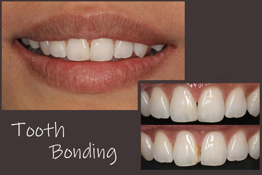 Closeup of smile before and after tooth bonding treatment