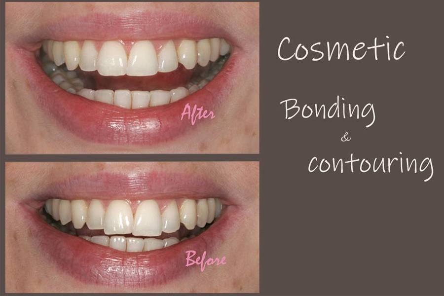 Smile before and after cosmetic bonding and contouring