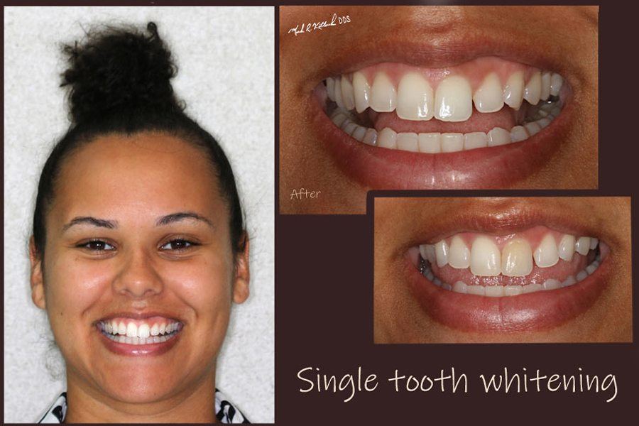 Smiel before and after single tooth whitening for individual discolored tooth