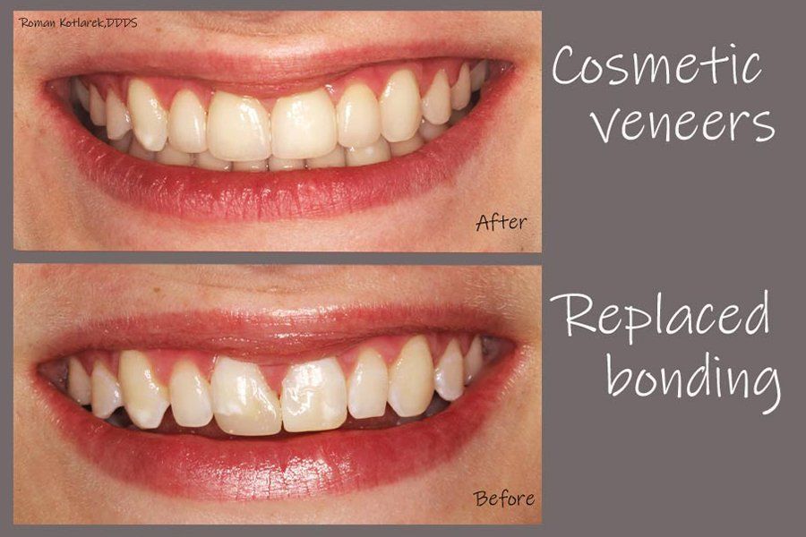 Smile before and after replacing dental bonding with porcelain veneers