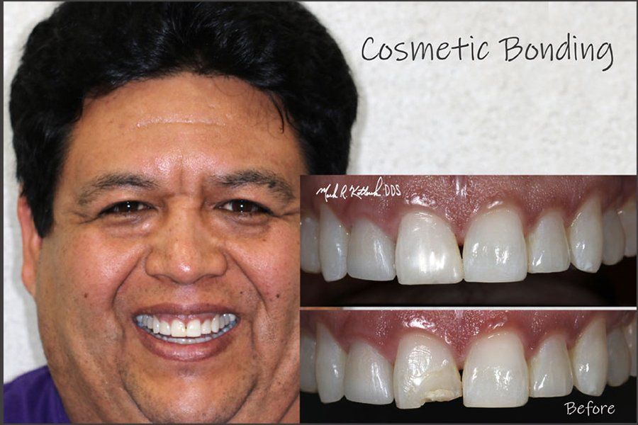 Smile before and after cosmetic dental bonding
