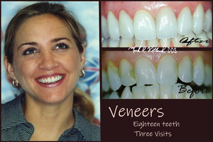 Woman with beautiful smile after veneers and closeup of before and after smile images