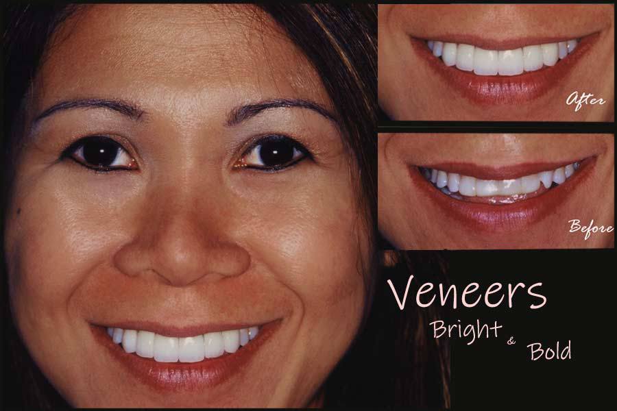 Closeup of patient with perfected smile thanks to veneers