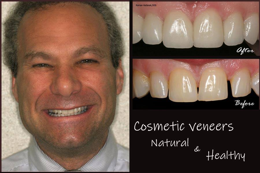 Man with perfected smile after treatment with veneers