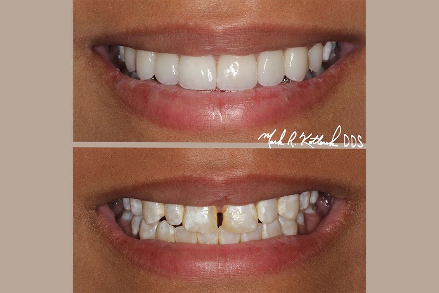 Closeup of smile before and after closing gap in teeth with cosmetic dentistry