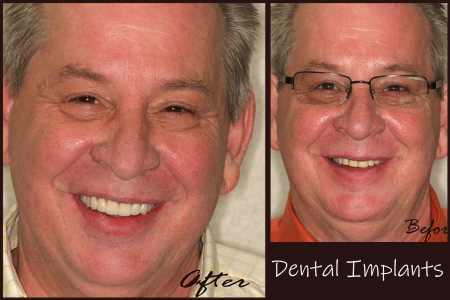 Man smiling before and after tooth replacement with dental implants