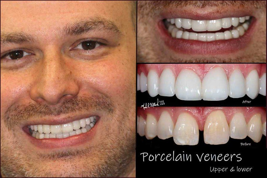 Smile before and after porcelain veneers