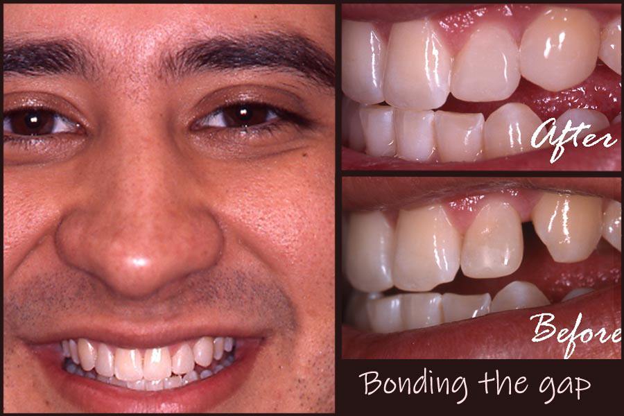 Man's smile before and after dental bonding is used to close gap between teeth