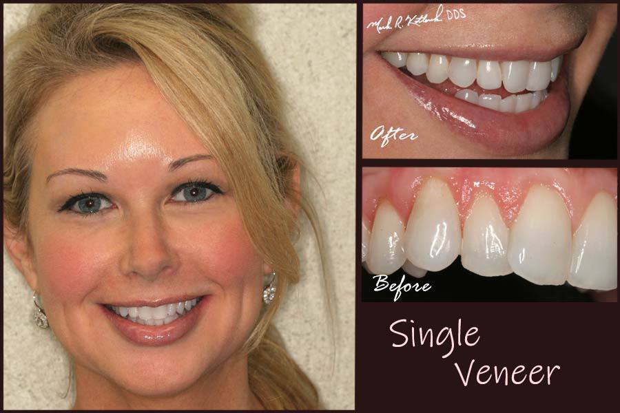 Woman's smile before and after it is perfected with a single veneer