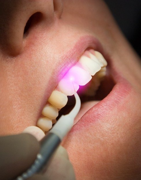 Patient having their gums treated with soft tissue laser