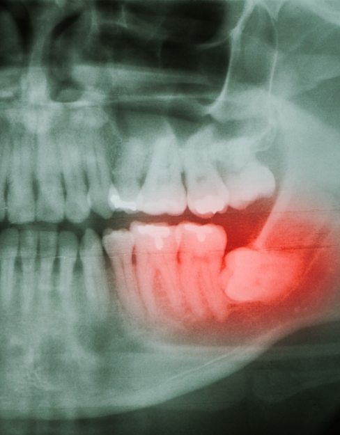 X-ray showing impacted wisodm tooth that needs to be extracted