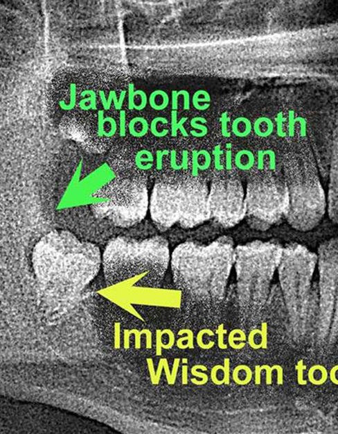 X-ray of smile showing impacted wisdom tooth before extraction