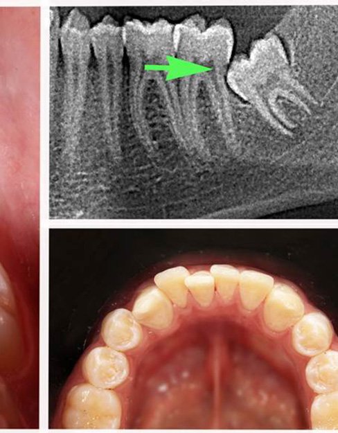 X-ray and closeup of smile used to guide surgical tooth extractions
