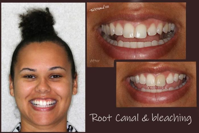 Dental patient's smile before and after root canal therapy