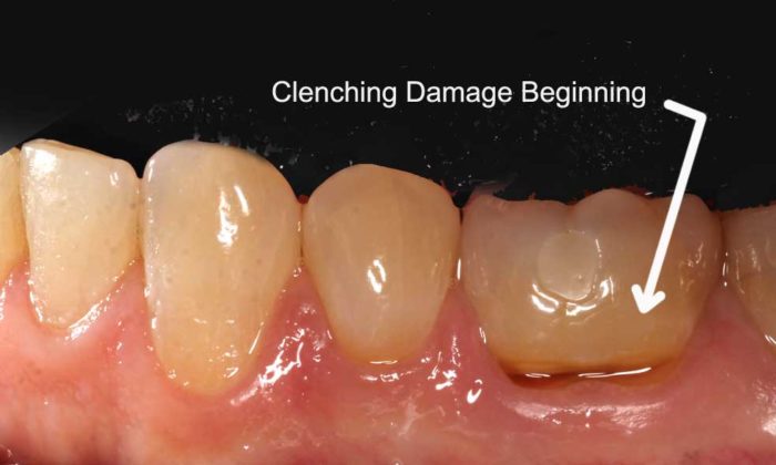 Clencing damage beginning