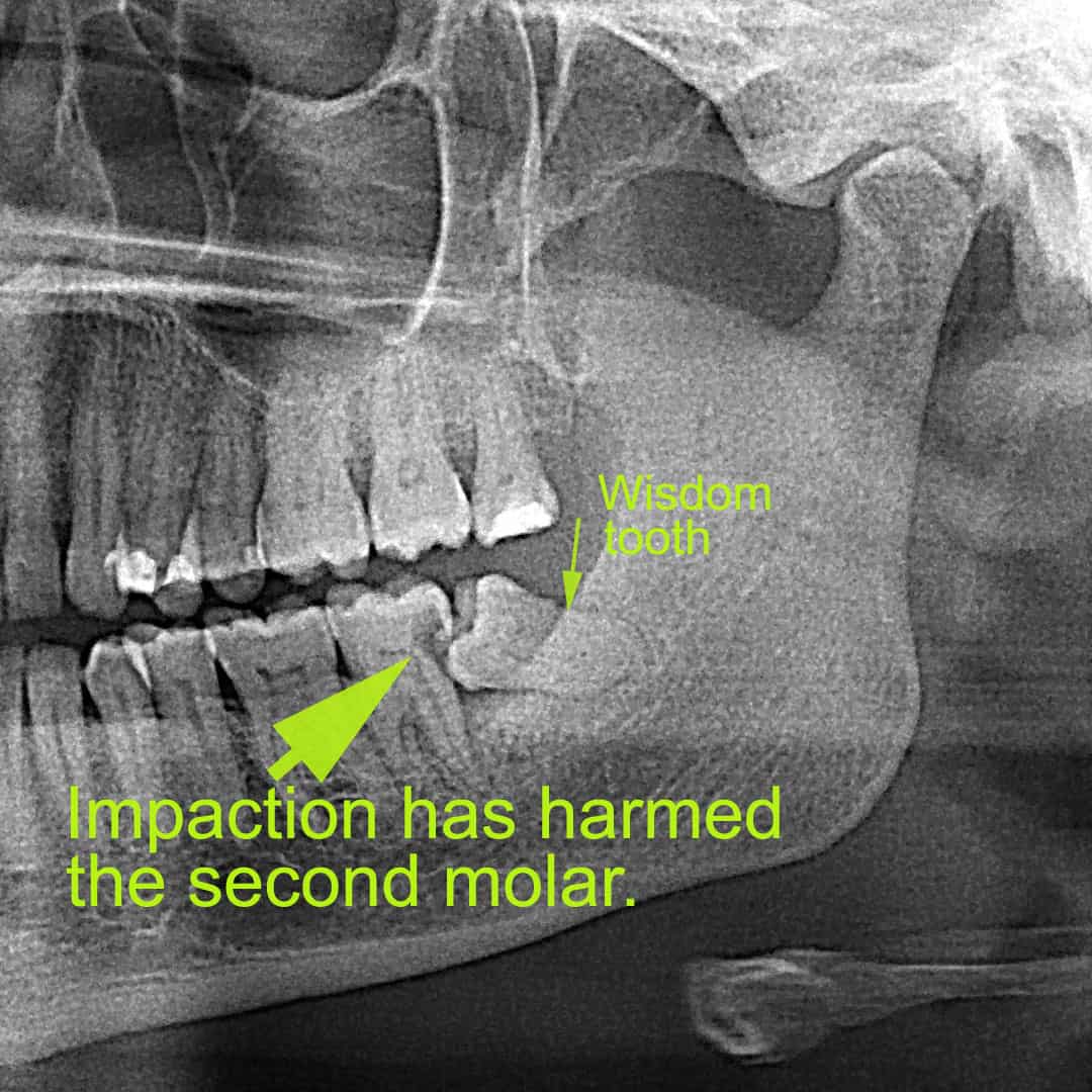 Impacted wisdom tooth xray