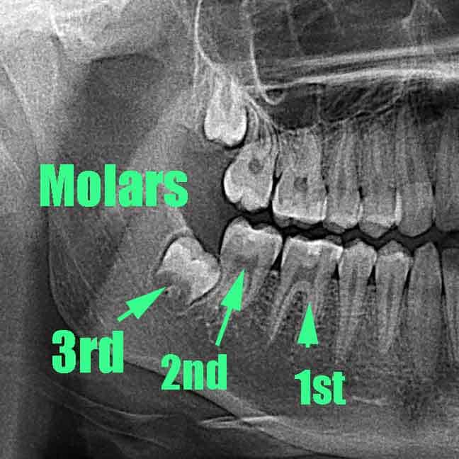 Third molar location