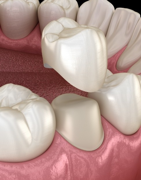 Dental Crowns Houston TX