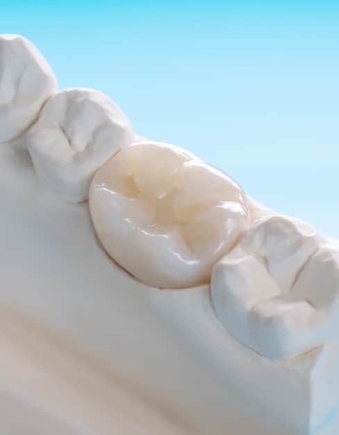 Dental Crowns Bellaire TX