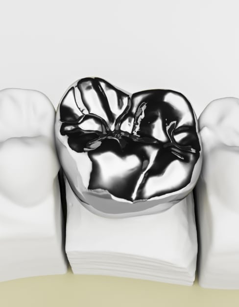 Porcelain Veneer Bellaire TX