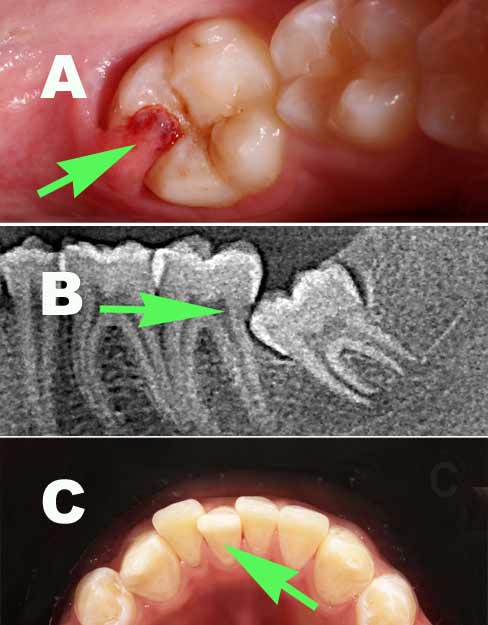 impaction problems