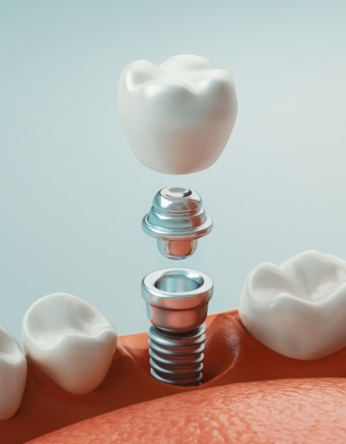 Tooth Removal Houston TX