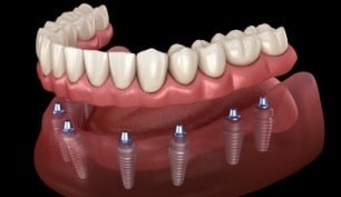 implants 8