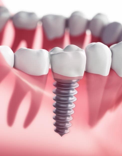 Replace Missing Teeth Bellaire TX
