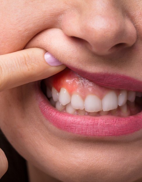 periodontal 2