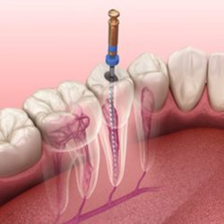 A diagram of a root canal.