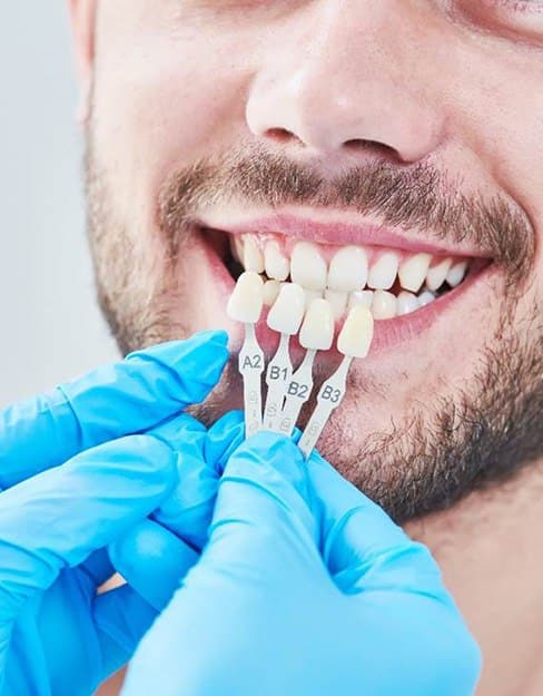 veneers 2