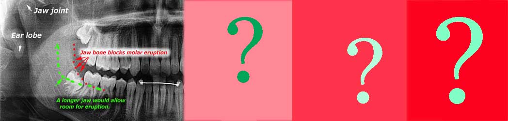 wisdom teeth questions