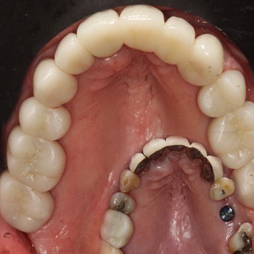 Before Image: Dental Implant - front
