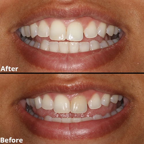 Before Image: Teeth Whitening - front