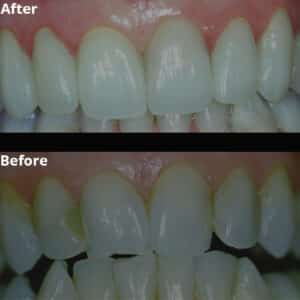 Before Image: Cosmetic Veneers