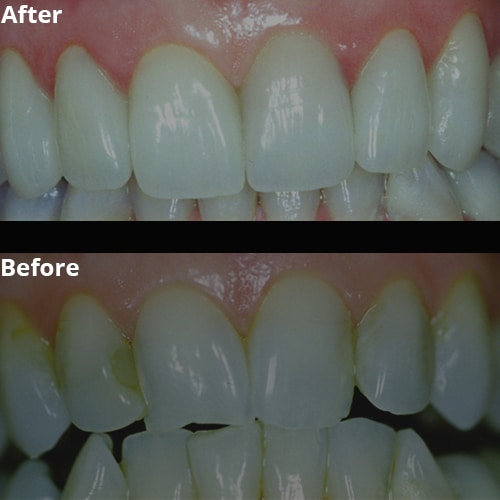 Before Image: Cosmetic Veneers - front