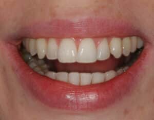 After Image: Dental Bonding Contouring