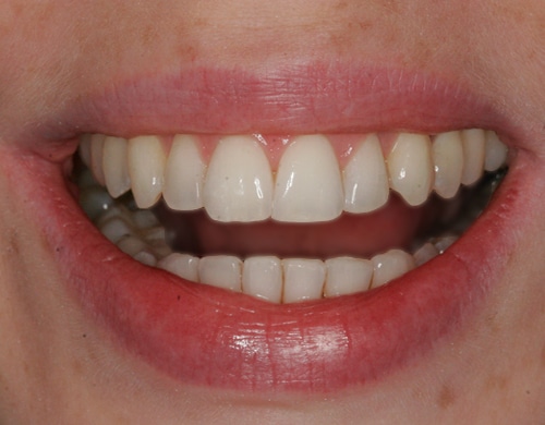 After Image: Dental Bonding Contouring - front