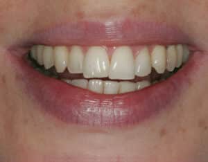 Before Image: Dental Bonding Contouring